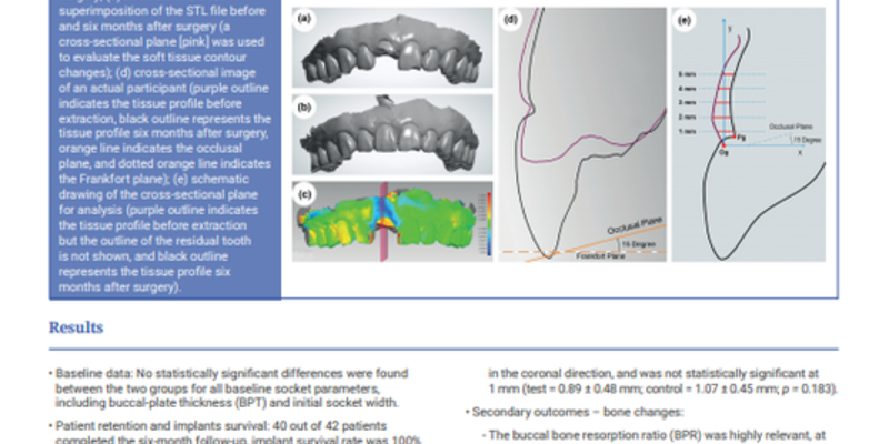 JCP Digest considers benefits of connective-tissue grafts as adjunct to immediate implant placement