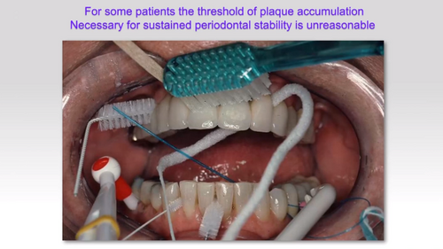 How to motivate patients, air-polishing, and online risk assessment – Iain Chapple answers questions on Step 1 of Guideline