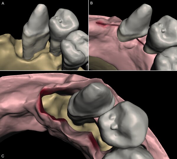 Graphic, Virtual surgical simulation