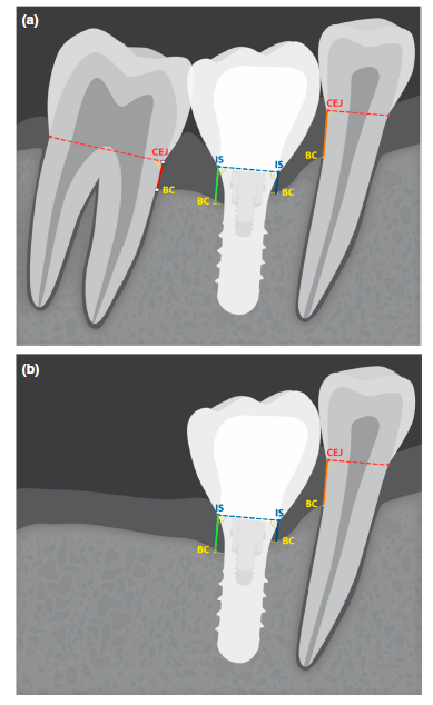 Graphic of teeth and implants